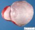 Congenital sacrococcygeal immature teratoma