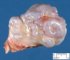Osteochondroma