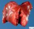 Hepatoblastoma