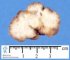 Colorectal juvenile polyp
