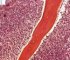 Bone marrow infiltration by large myeloid cells in Kostmann (...)