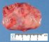 Neuroblastoma
