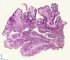 Botryoid Wilms tumor