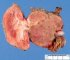 Juxta-renal nodal metastasis of mixed germ cell tumor of the (...)