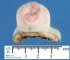 Meningoencephalocele
