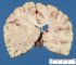 Periventricular cortical heterotopia