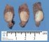 Thyroid papillary carcinoma
