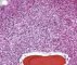 Bone marrow localization of a classic Hodgkin lymphoma