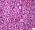 Acute inflammation with granulocytic diapedesis in ileal Crohn (...)