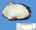 Embryonal rhabdomyosarcoma