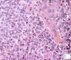 Ewing sarcoma