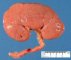Multiple fungal abcesses under the renal capsule