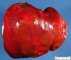 Hepatic ischemia in a liver allograft