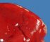Hepatic lesions in Meckel syndrome