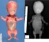 Thanatophoric dysplasia (20 weeks)