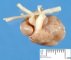 Aortic arch hypoplasia (Case 10783)