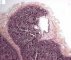 Fetal oligocystic kidneys of unknow cause (case 11389)