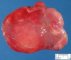 Myxoid liposarcoma