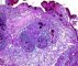 Intestinal metaplasia in stomach (ABPAS)