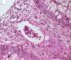 Adenoviral colonic infections