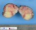 Alveolar rhabdomyosarcoma of limbs