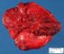 Cervical desmoid fibromatosis