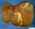 Hepatic hilus with gallbladder