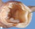 Ileal duplication cyst