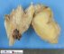Localized neurofibroma in neurofibromatosis type 1