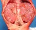 Bilateral non-obstructive renal dysplasia (BNORD) in Meckel (...)