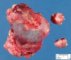 mediastinal poorly differentiated neuroblastoma