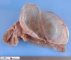 Mesenteric cystic lymphangioma