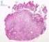Duodenal infantile myofibromatosis