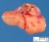 Parotidal emryonal rhabdomyosarcoma