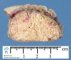 Pilomatricoma (pilomatrixoma)
