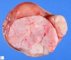 Chondroid teratoma component of a mixed germ cell tumor (yolk sac (...)