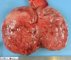 Seminoma of the testis