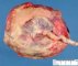 Complete placenta circumvallata