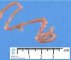 Meckel diverticula (Fetus 19 weeks)