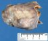 Splenic mesothelial cyst
