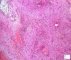 Osseous infantile myofibromatosis