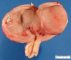 Uterine leiomyoma under the mucosa