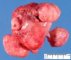 Multiple uterine leiomyomas