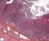 Acute appendicitis