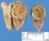 Acute appendicitis with fecalith