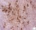CD30 in bone marrow localization of classic Hodgkin lymphoma