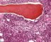 Bone marrow metastasis of a neuroblastoma