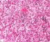 Nuclear and cytoplasmic inclusions in CMV fetopathy
