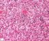 Nuclear and cytoplasmic inclusions in CMV fetopathy