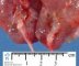 Bilateral ureteropelvic junction obstruction